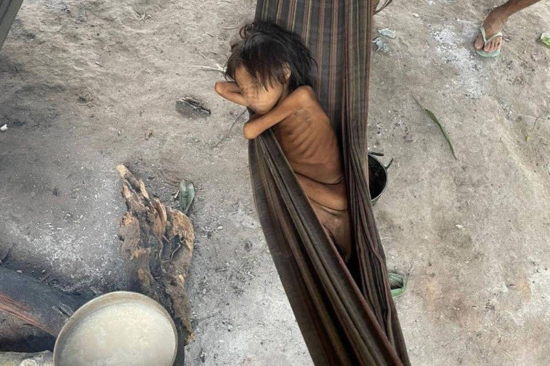 Criança Yanomami com desnutrição e malária, na aldeia Maimasi.
Foto: Divulgação