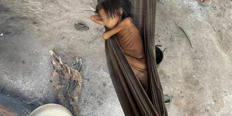Criança Yanomami com desnutrição e malária, na aldeia Maimasi.
Foto: Divulgação