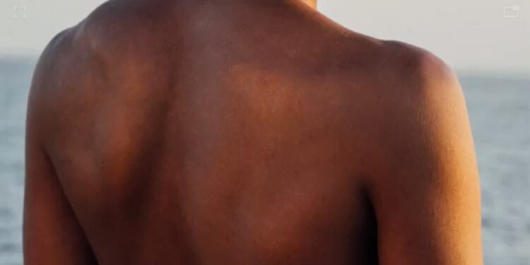 Foto: Instituto Melanoma Brasil/Capa Vídeo