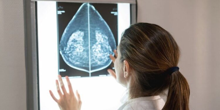 Mamografias no SUS em pacientes com menos de 50 anos representam 30% do total, equivalente a mais de 1 milhão em 2024. Foto: GettyImages